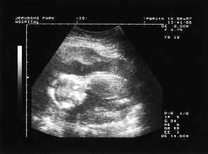 foetus120697.jpg (7425 bytes)